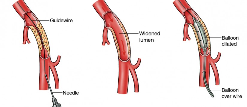 Peripheral Artery Imaging and Intervention: A Comprehensive Guide to Angiography and Angioplasty Peripheral Artery Imaging and Intervention: A Comprehensive Guide to Angiography and Angioplasty