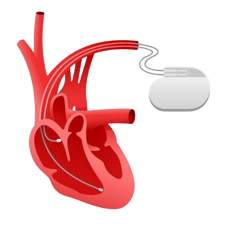 152226183 pacemaker cardio stimulator icon heart implant medical device scheme and human heart in removebg preview