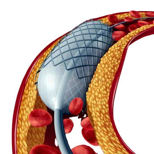 angioplasty stent concept as heart disease treatment symbol implant artery has cholesterol plaque 77503342 removebg preview